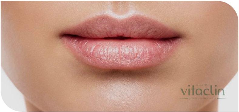 Preenchimento Labial