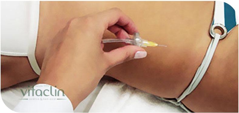 Carboxiterapia