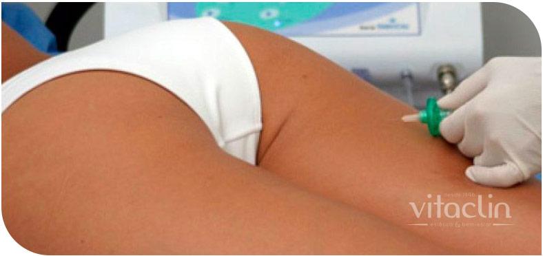 Carboxiterapia