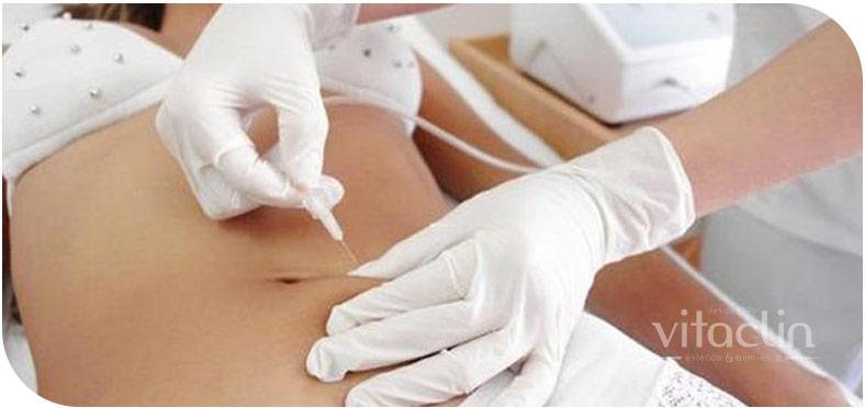 Carboxiterapia