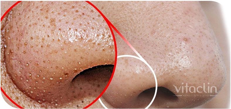 Procurando tratamento para Acne? Temos 25 anos 