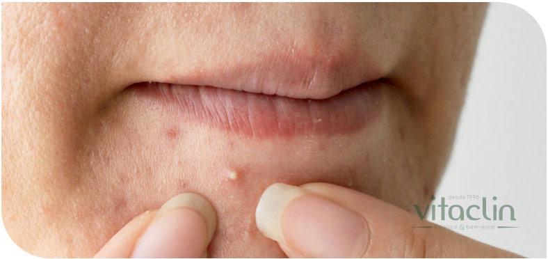 Procurando tratamento para Acne? Temos 25 anos 