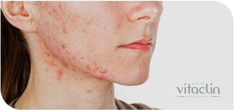 Procurando tratamento para Acne? Temos 25 anos 