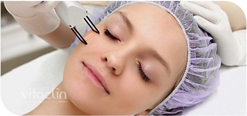 Procurando tratamento para Acne? Temos 25 anos 