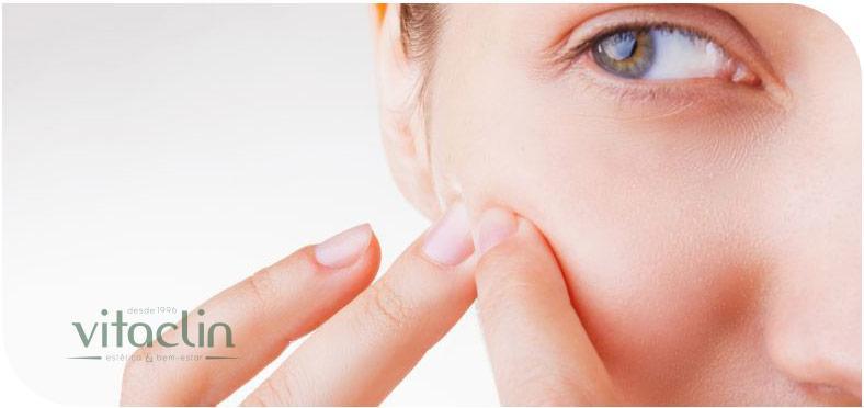 Procurando tratamento para Acne? Temos 25 anos 