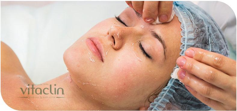 Peeling de Ácido Tricloroacético 