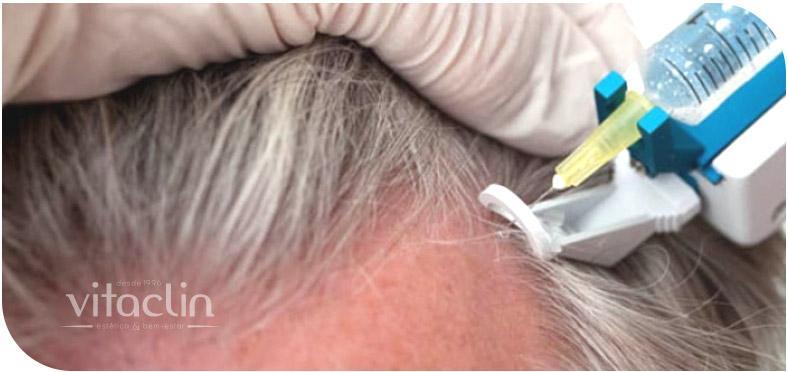 Mesoterapia Capilar em Curitiba