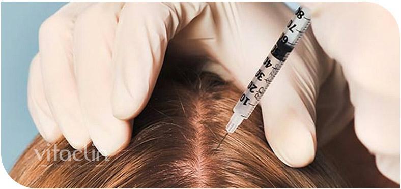 Mesoterapia Capilar em Curitiba